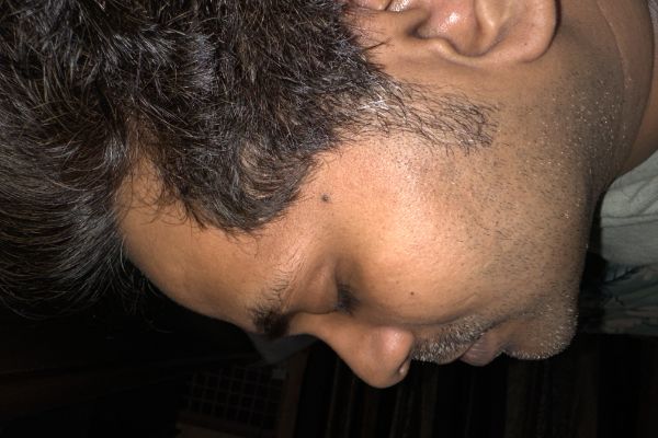 After - Chemical peeling treatment