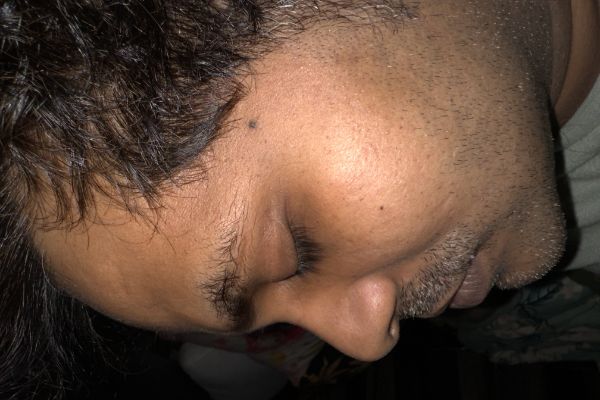 Before - Chemical peeling treatment