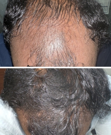 GFC & PRP Therapy at Niralya Skin Clinic