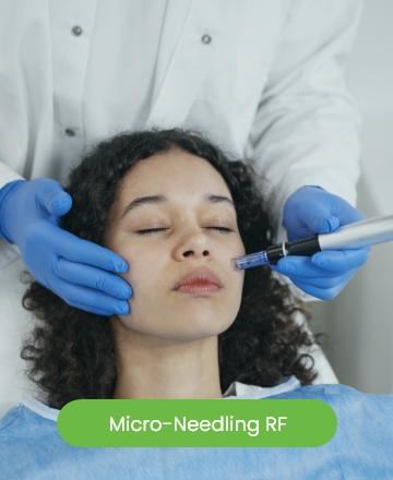 Microneedling Treatment
