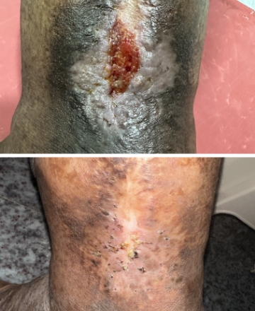 Large skin tag laser removal before and after